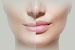 All About Dermal Filler