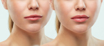 Lip Fillers Dubai