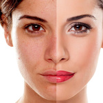 Pigmentation Treatment in Dubai