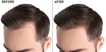 Hair Transplant in Dubai 