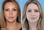 Sculptra Fillers in Dubai