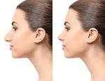 FREQUENTLY ASKED QUESTIONS REGARDING RHINOPLASTY