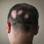 Alopecia Areata Treatment in Dubai