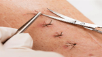 Suture Removal At Home in Dubai