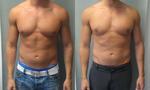 Remove the Fat and Regain A Flat Stomach Using Vaser Lipo Treatment